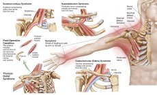Ilustración médica que detalla el síndrome de salida torácica - foto de stock