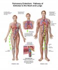 Медична ілюстрація легеневої емболії — стокове фото