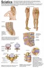 Medical chart showing the signs and symptoms of sciatica — Stock Photo
