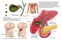 Ilustración médica de cálculos biliares en la vesícula biliar y la colecistectomía - foto de stock