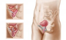 Anatomy of bladder suspension procedure for urinary incontinence — Stock Photo