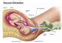 Medical illustration of delivery of fetus using vacuum extraction — Stock Photo