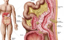 Ilustración médica de la diverticulosis en el colon - foto de stock