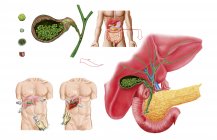 Ilustración médica de cálculos biliares en la vesícula biliar y la colecistectomía - foto de stock