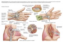 Ilustración médica del síndrome del túnel carpiano en la muñeca humana - foto de stock