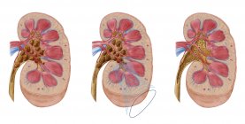 Порівняння різних каменів нирок у людській нирці — стокове фото