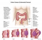 Illustrazione medica raffigurante le diverse fasi del cancro al colon — Foto stock