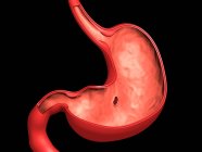 Ilustración médica de úlcera péptica en el estómago humano - foto de stock