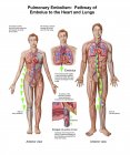 Ilustración médica de la embolia pulmonar - foto de stock