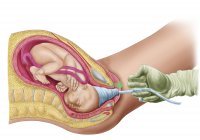 Медицинская иллюстрация родов плода с помощью вакуумной экстракции — стоковое фото