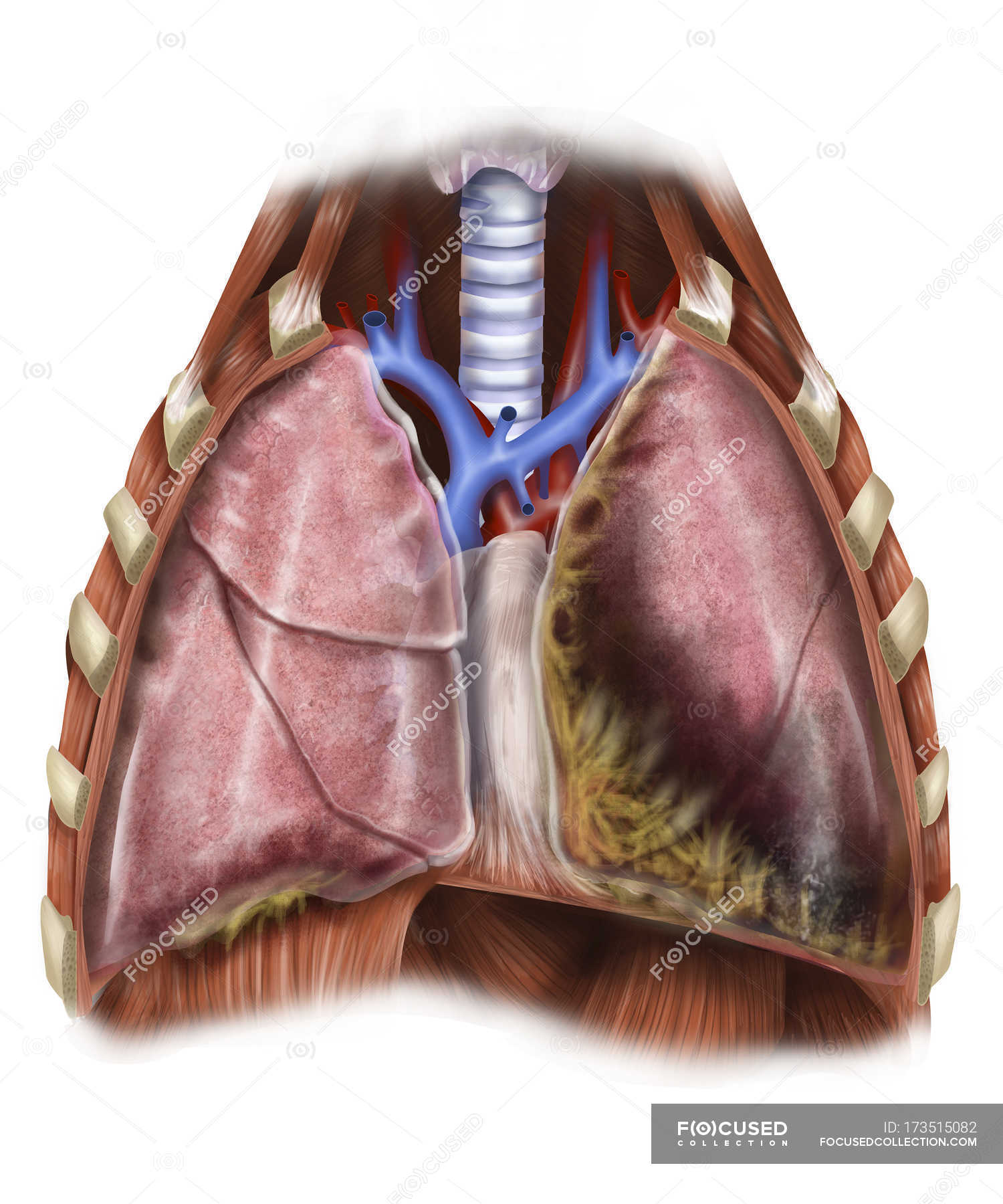 mesothelioma chemo