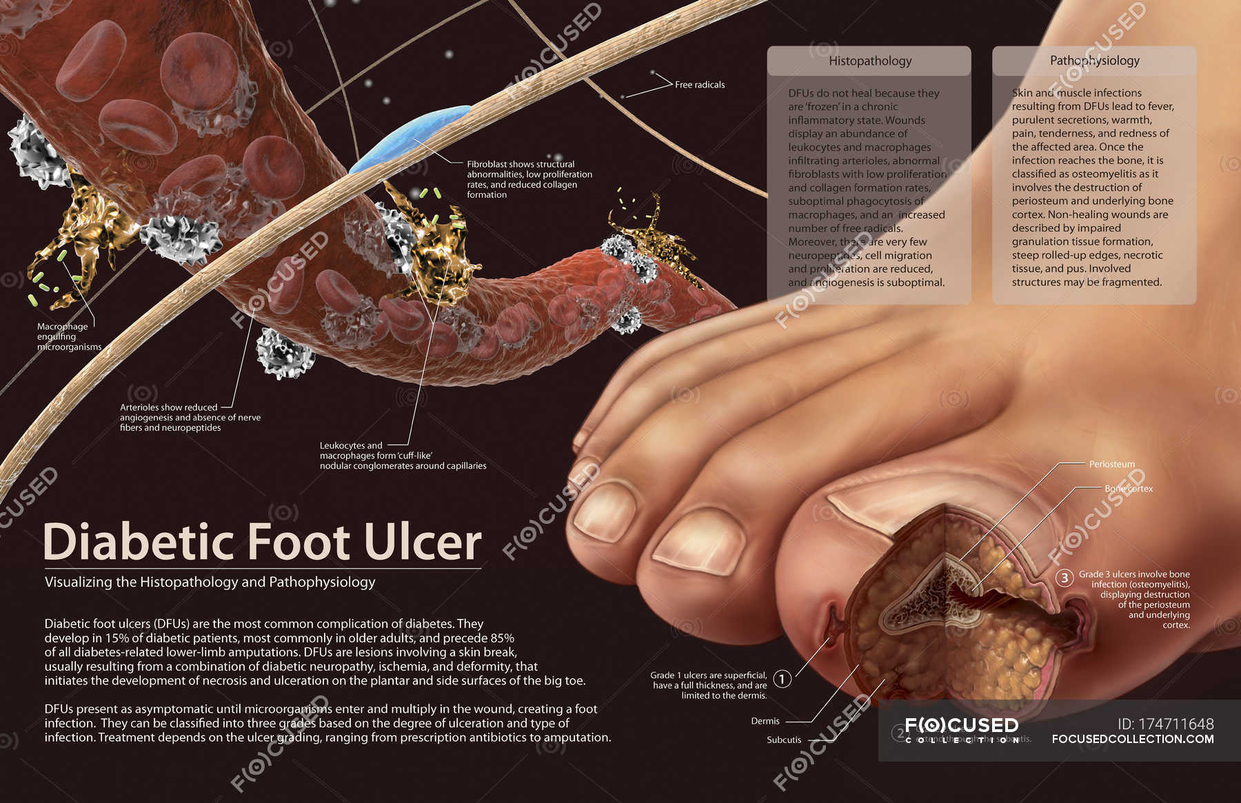 Pathophysiology of diabetic foot ulcers — color image, cross section