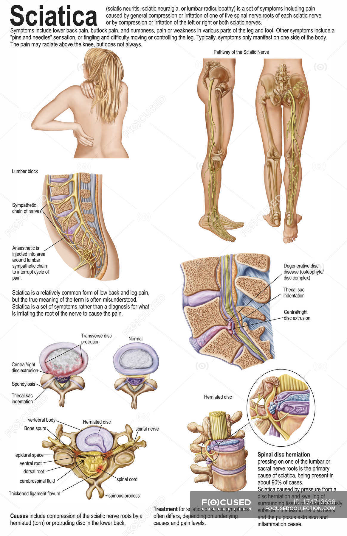 Signs Of Sciatica Improving Reddit