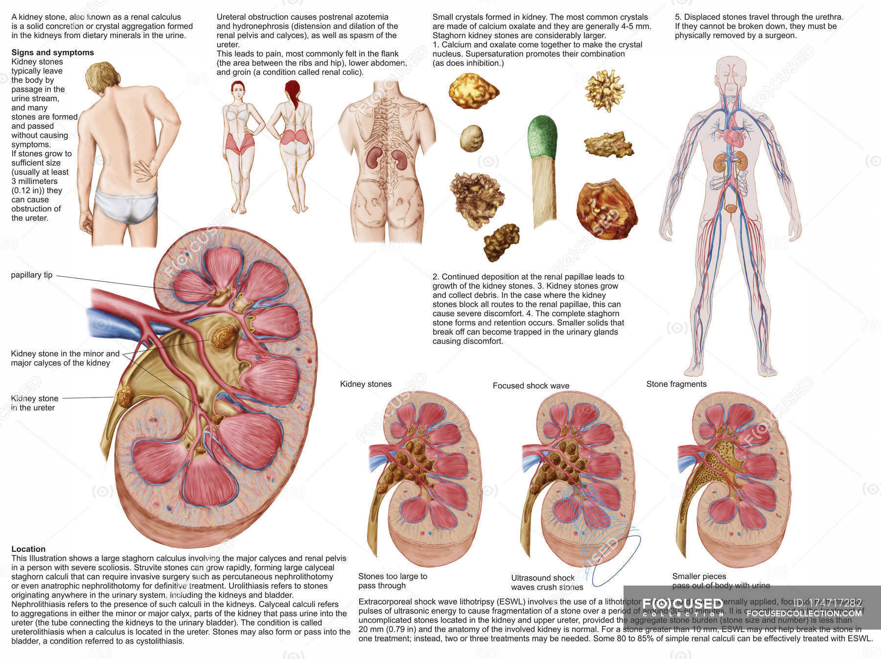 Medical chart with the signs and symptoms of kidney stones — renal