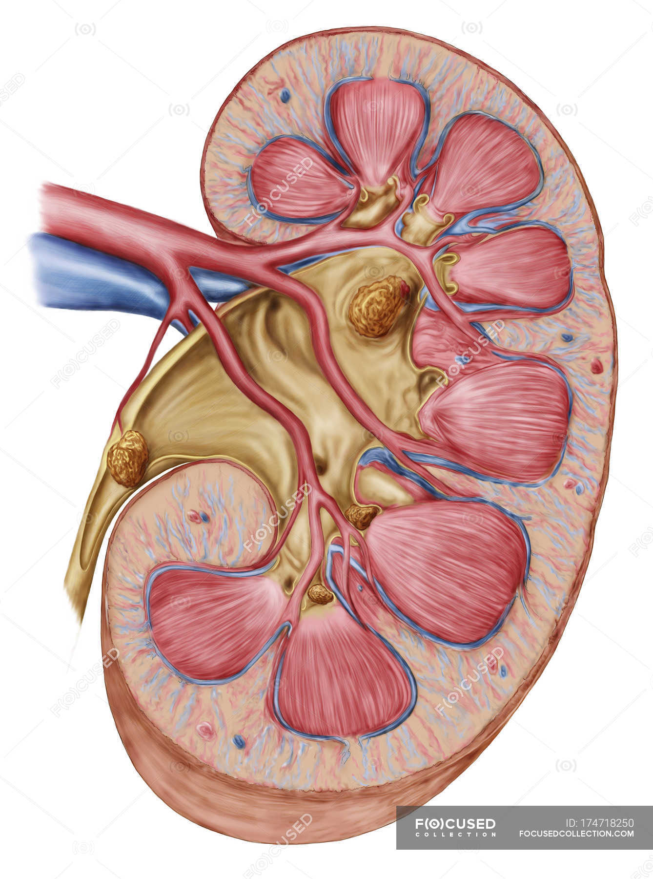 Large staghorn calculus in the human kidney — renal papilla, nephrosis