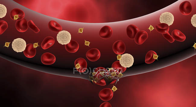 Ilustración médica del proceso de coagulación de la sangre dentro de la arteria - foto de stock