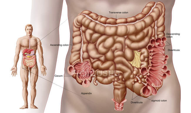 Ilustración de diverticulitis en el colon descendente del intestino humano - foto de stock