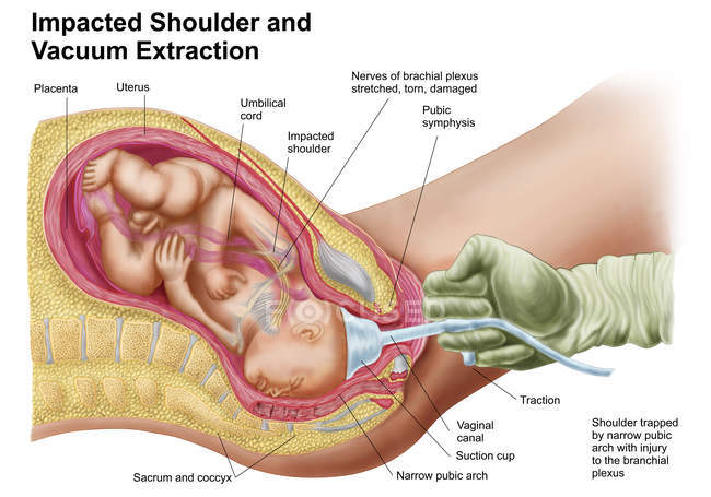 Медицинская иллюстрация родов плода с помощью вакуумной экстракции — стоковое фото