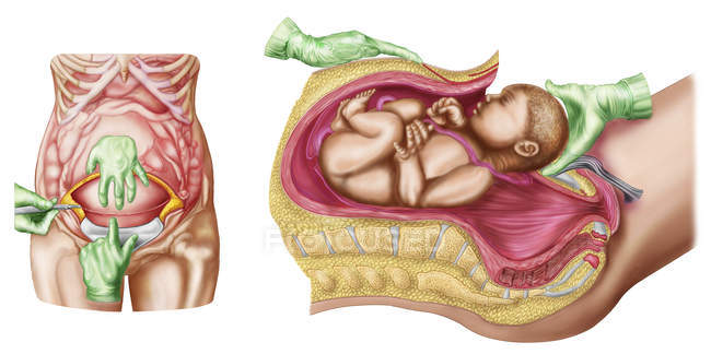 Медицинская иллюстрация, показывающая кесарево сечение плода — стоковое фото