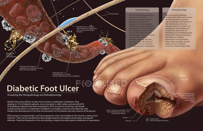 Fisiopatología de las úlceras del pie diabético - foto de stock