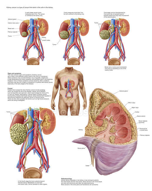Медичні діаграми з ознаки і симптоми раку нирки — стокове фото