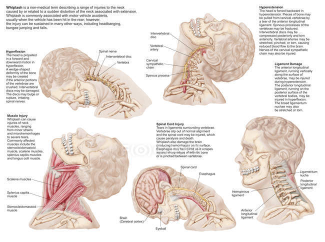Medizinisches Diagramm mit der Bandbreite der Verletzungen am menschlichen Hals — Stockfoto