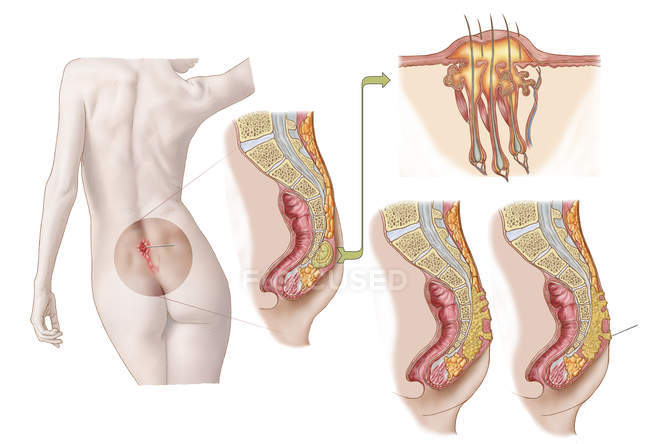 Ilustração médica de um cisto pilonidal perto da fenda natal das nádegas — Fotografia de Stock