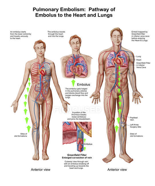 Illustration médicale d'une embolie pulmonaire — Photo de stock