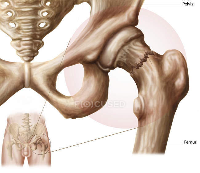 Анатомія переломів кульшового суглоба медична ілюстрація — стокове фото