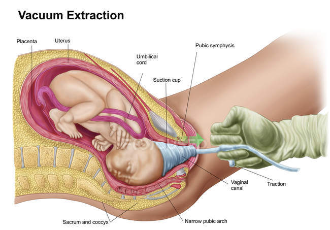 Illustrazione medica della consegna del feto mediante estrazione sotto vuoto — Foto stock