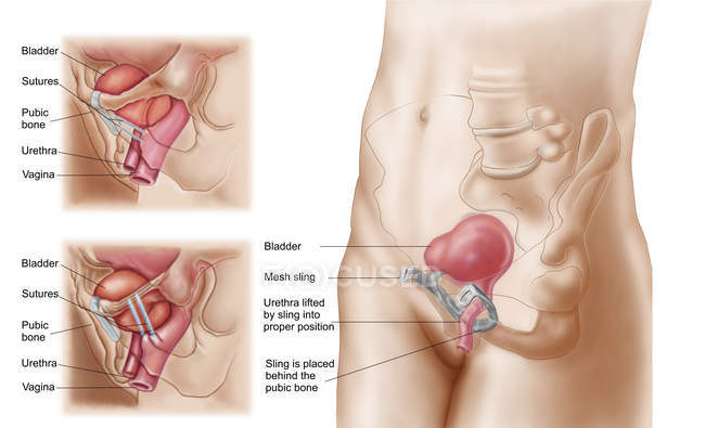 Anatomy of bladder suspension procedure for urinary incontinence — Stock Photo