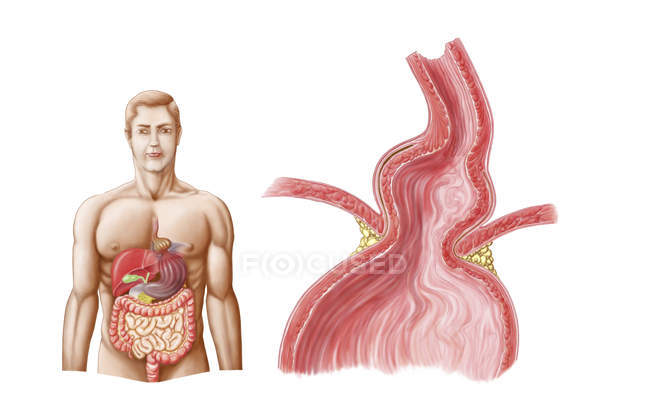 Медицинская иллюстрация гиатальной грыжи желудка в грудную клетку — стоковое фото