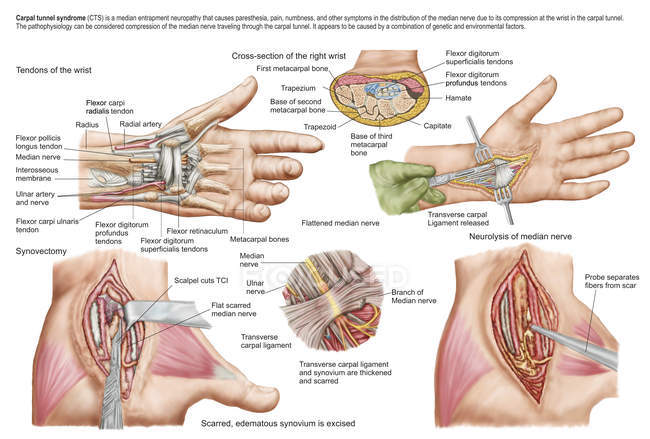 Ilustração médica da síndrome do túnel do carpo no pulso humano — Fotografia de Stock