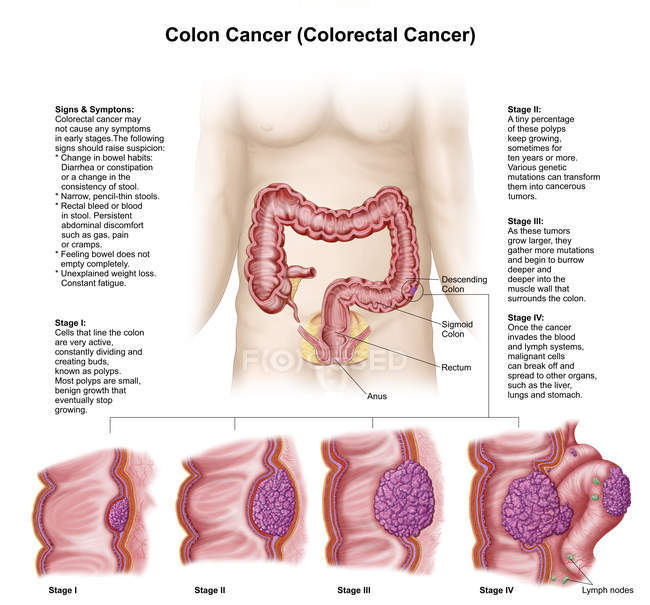Медицинская иллюстрация, изображающая различные стадии рака толстой кишки — стоковое фото