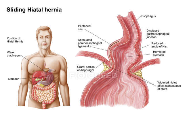 Ilustración médica de una hernia de estómago hiatal en el tórax - foto de stock
