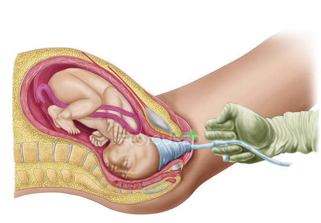 Medizinische Illustration der Geburt des Fötus mittels Vakuumextraktion — Stockfoto