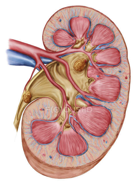 Large staghorn calculus in the human kidney — Stock Photo