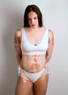 Junge Frau mit Vitiligo-Krankheit posiert im Studio in einem weißen Bikini — Stockfoto
