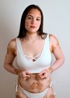Молодая женщина, с болезнью витилиго, позирует в студии в белом бикини — стоковое фото