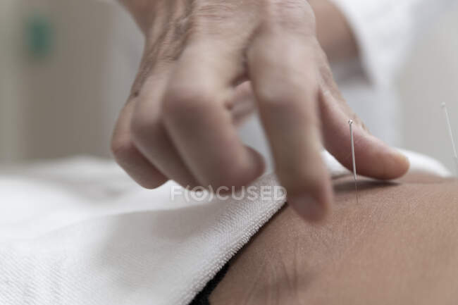Tiro recortado del hombre que realiza la acupuntura para el paciente femenino - foto de stock