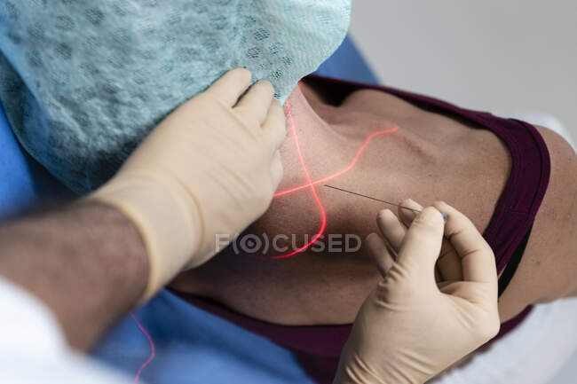 Primo piano del medico che esegue una puntura con ago e croce laser sul corpo della donna — Foto stock