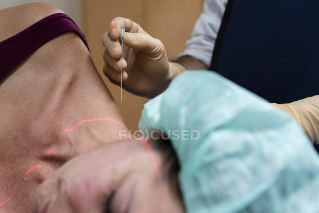 Primer plano del médico que realiza la punción con aguja y cruz láser en el cuerpo de la mujer - foto de stock
