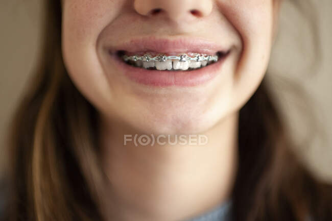 Primer plano de los frenos en los dientes de una adolescente contra la pared en blanco - foto de stock