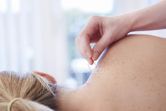 Woman receiving acupuncture in shoulder — Stock Photo