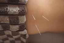 Close-up of male patient getting dry needling on waist — Stock Photo