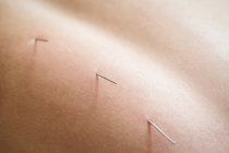 Nahaufnahme des Patienten, der trockene Nadeln auf den Rücken bekommt — Stockfoto