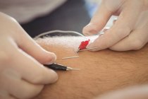 Крупный план рук физиотерапевта, выполняющих электро-сухую иглу на коленях пациента мужского пола — стоковое фото
