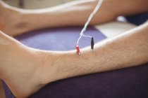 Primer plano de un paciente recibiendo agujas electro-secas en la pierna - foto de stock