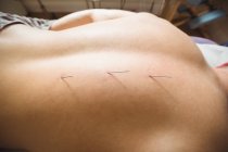 Close-up of patient getting dry needling on back in clinic — Stock Photo