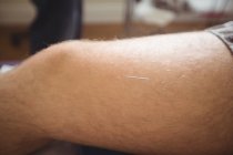 Close-up of male patient getting dry needling on knee — Stock Photo